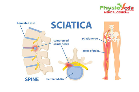 Breaking free from sciatica: How physiotherapy changes lives